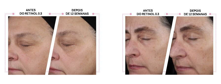 Retinol 03 Before and after 